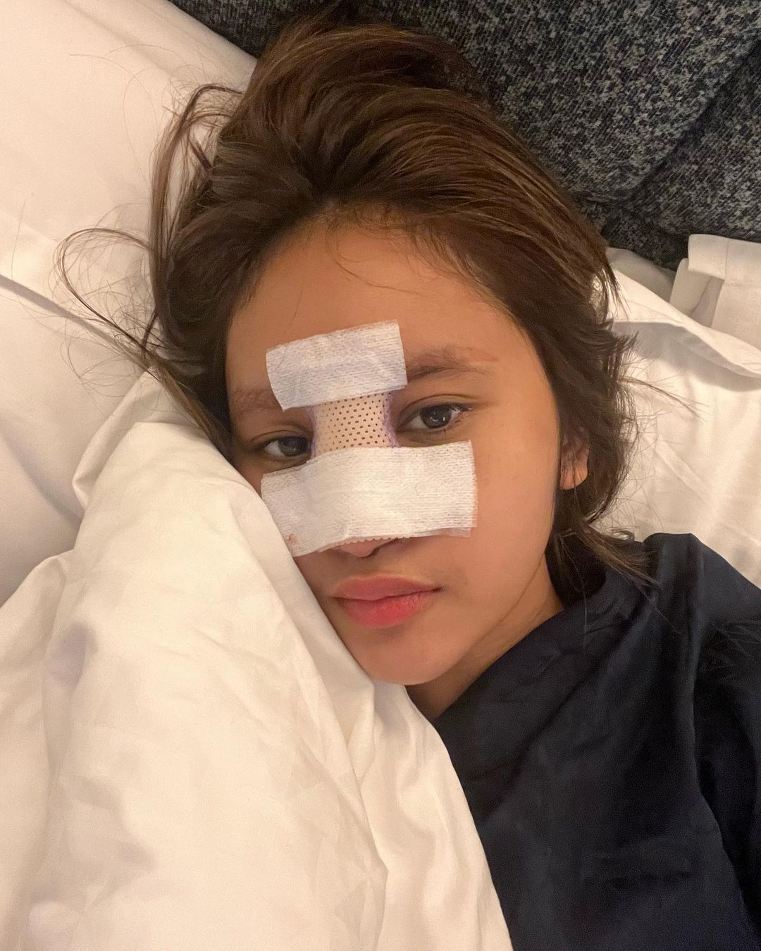 Permesta Dhyaz Usai Angkat Implan Hidung yang Infeksi