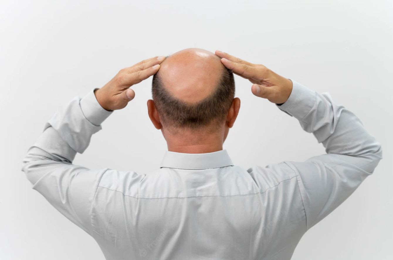 Memanggil Pria dengan Sebutan Botak di Inggris Termasuk Pelecehan Seksual