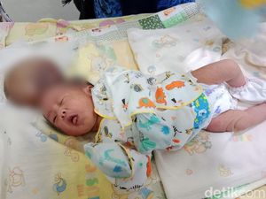 Sedih! Bayi Perempuan di Ciamis Derita Benjolan Sebesar Kepala