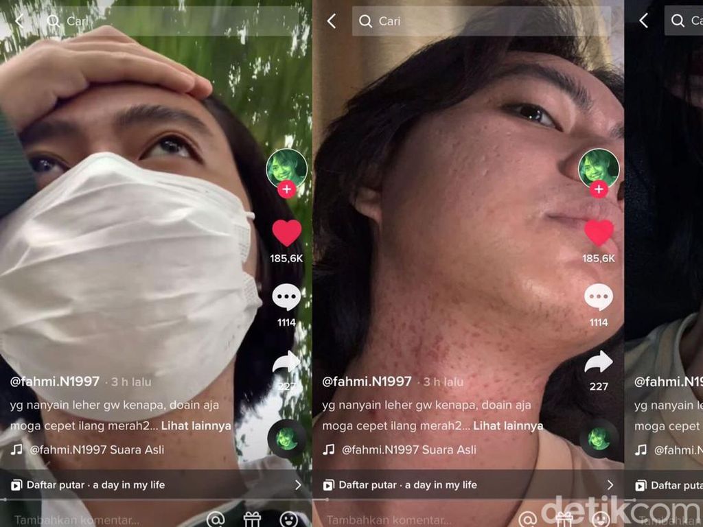 Viral Netizen Mengeluh Muncul Bintik Merah di Leher, Gara-gara Cuaca Panas? Viral Netizen Mengeluh Muncul Bintik Merah di Leher, Gara-gara Cuaca Panas?