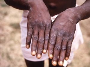 WHN Tandingan WHO Tetapkan Cacar Monyet Jadi Pandemi, Epidemiolog: Tidak Sah! WHN Tandingan WHO Tetapkan Cacar Monyet Jadi Pandemi, Epidemiolog: Tidak Sah!