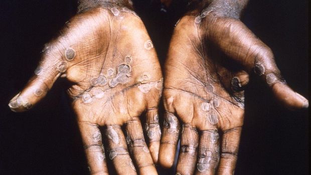 The palms of a monkeypox case patient from Lodja, a city located within the Katako-Kombe Health Zone, are seen during a health investigation in the Democratic Republic of Congo in 1997. Picture taken in 1997.  Brian W.J. Mahy/CDC/Handout via REUTERS. THIS IMAGE HAS BEEN SUPPLIED BY A THIRD PARTY. IT IS DISTRIBUTED, EXACTLY AS RECEIVED BY REUTERS, AS A SERVICE TO CLIENTS