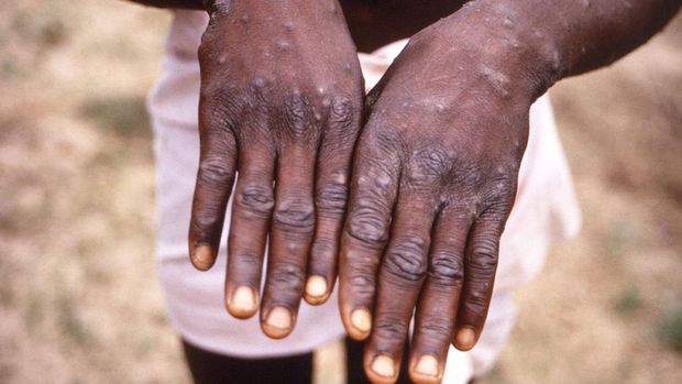 An image created during an investigation into an outbreak of monkeypox, which took place in the Democratic Republic of the Congo (DRC), 1996 to 1997, shows the hands of a patient with a rash due to monkeypox, in this undated image obtained by Reuters on May 18, 2022. CDC/Brian W.J. Mahy/Handout via REUTERS THIS IMAGE HAS BEEN SUPPLIED BY A THIRD PARTY.