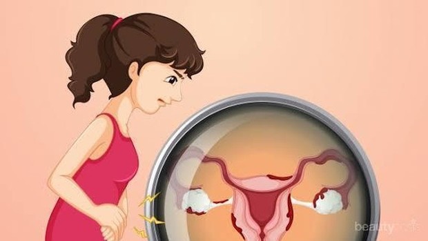 Ilustrasi gejala kanker ovarium