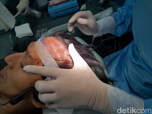 Lagi Trending, Berapa Sih Biaya Transplantasi Rambut? Lagi Trending, Berapa Sih Biaya Transplantasi Rambut?