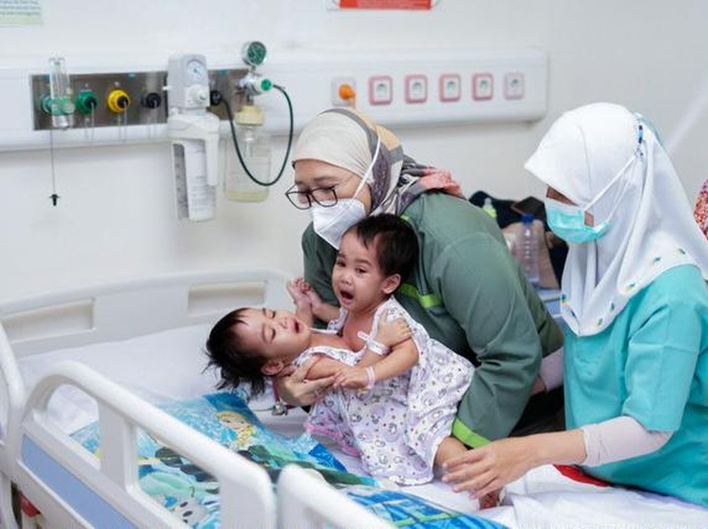 Kondisi Bayi Kembar Siam Sukabumi Usai Operasi Pemisahan