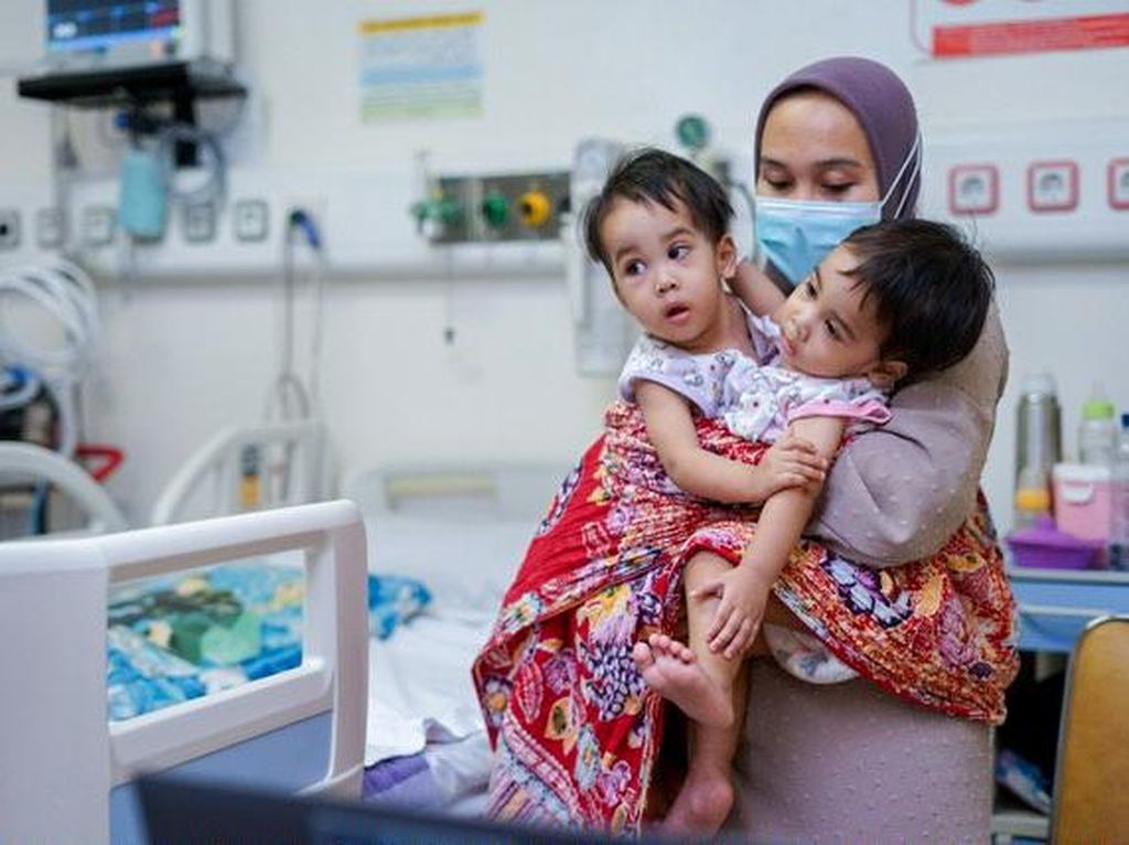 Bayi Kembar Siam Sukabumi Jalani Operasi Pemisahan di RSHS