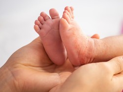 Flu Singapura Rentan Serang Anak, Dokter Ungkap Gejala Awal yang Muncul