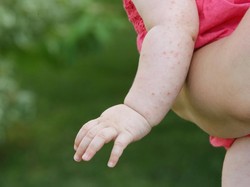 Gejala Flu Singapura pada Anak, Penyebab, dan Cara Mengobatinya