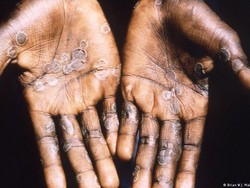 Uni Eropa: Lebih dari 200 Kasus Cacar Monyet Terdeteksi di Seluruh Dunia