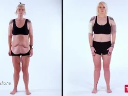 Curhatan Sedih Wanita Turun BB Sampai 107 Kg, Begini Kondisi Kulit Perutnya