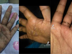Viral Curhat Wanita Gagal Jadi Cantik Gegara Tangan Bernanah, Ini Ceritanya