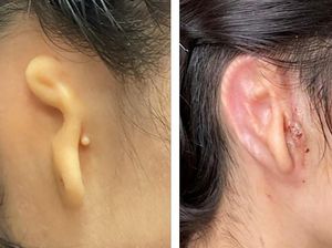 Wanita Ini Jadi Orang Pertama yang Dapat Transplantasi Telinga 3D