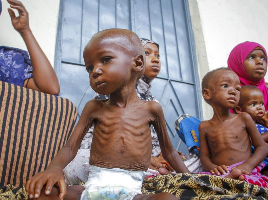Foto Ini Tunjukkan Penderitaan Anak-anak Somalia yang Kena Gizi Buruk Foto Ini Tunjukkan Penderitaan Anak-anak Somalia yang Kena Gizi Buruk