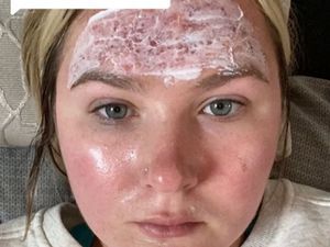 Ini Dampak Memakai Sunscreen Kedaluwarsa, Jangan Disepelekan!