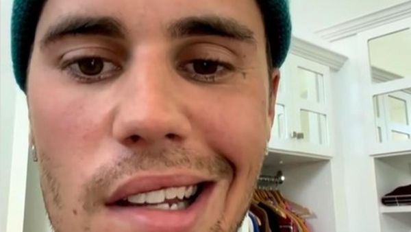 Kondisi Wajah Justin Bieber yang Idap Ramsay Hunt Syndrome