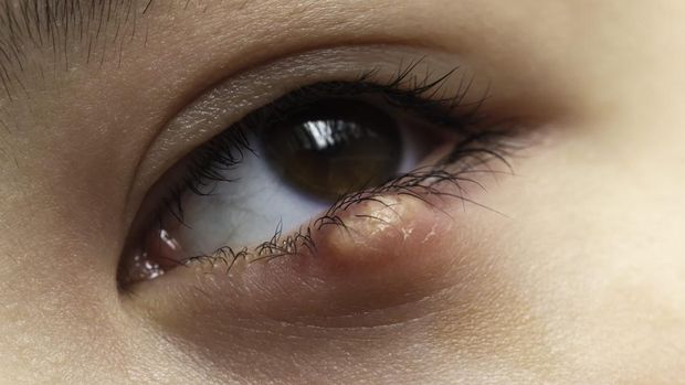Ilustrasi alergi di mata akibat makeup