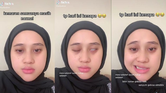 Bells palsy