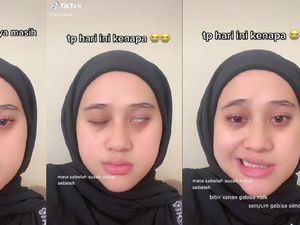 Viral Wanita Asal Tangsel Idap Bells Palsy, Wajah Kaku Bisa Permanen? Viral Wanita Asal Tangsel Idap Bells Palsy, Wajah Kaku Bisa Permanen?