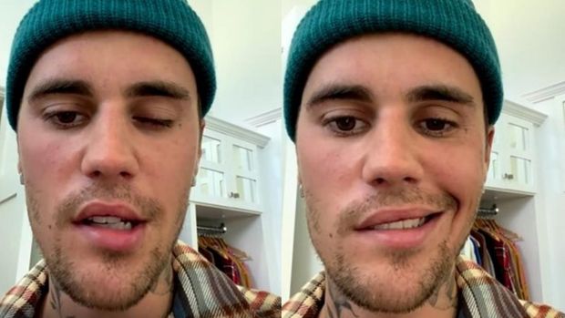 Justin Bieber Mengidap Sindrom Ramsay Hunt