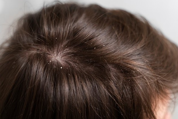 Mencuci rambut terlalu sering dapat menjadi penyebab ketombean