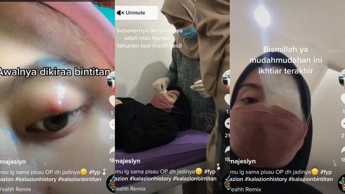 Viral TikTok Wanita Depok mengeluhkan tanda-tanda bintitan tak kunjung sembuh.