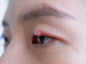 15 Obat Bintitan Alami, Kimia, dan Dosis Penggunaannya