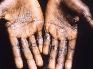 Komisi IX DPR Minta RI Intens Komunikasi dengan WHO soal Cacar Monyet