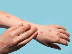 Kasus Cacar Monyet di Jakarta Terus Tambah, Gak Bahaya Tah?