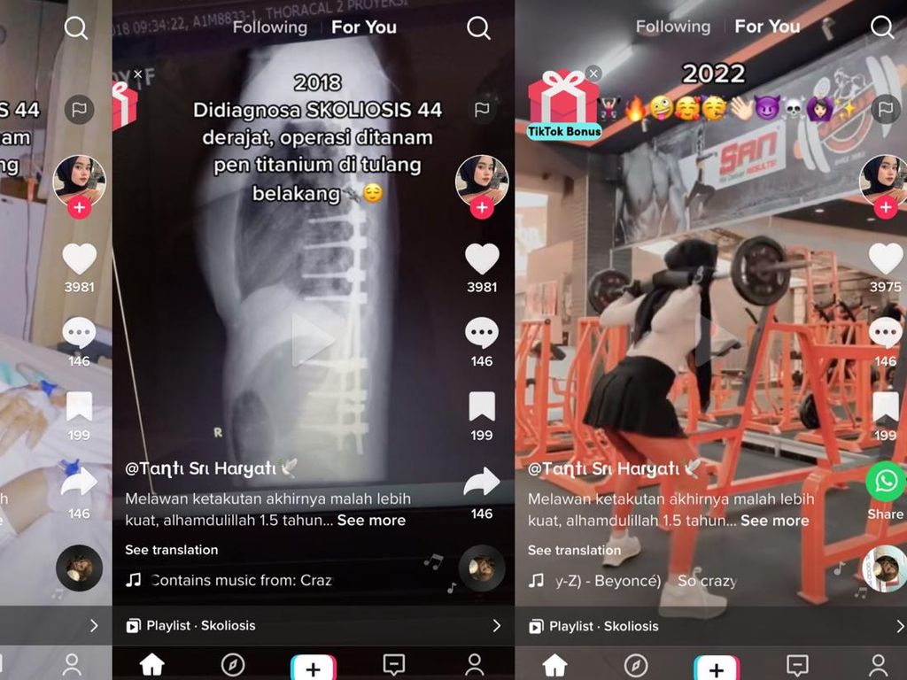 Penyebab Wanita Cimahi Viral Kena Skoliosis, Badan Kaku Kaya Robot Penyebab Wanita Cimahi Viral Kena Skoliosis, Badan Kaku Kaya Robot
