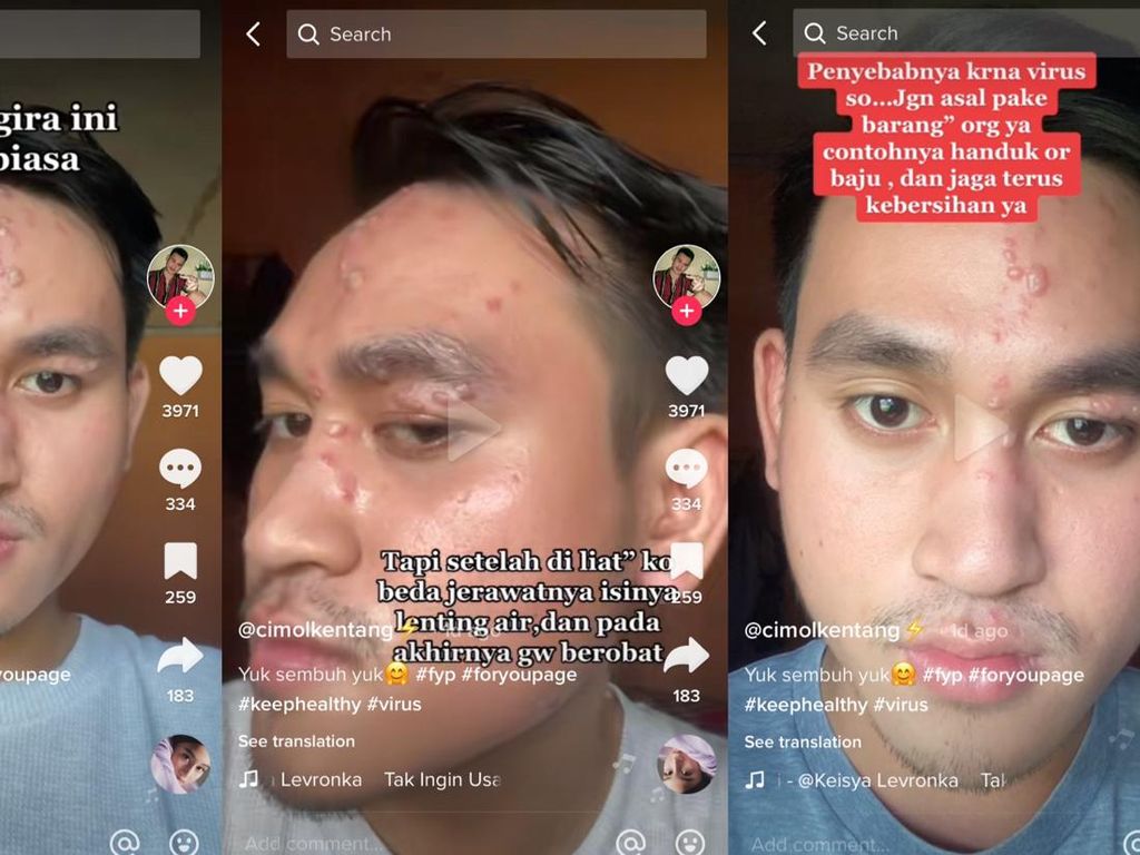 Cerita di Balik Viral Pria Jakarta Kena Herpes Zoster, Sempat Dikira Jerawat Biasa
