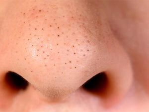 10 Cara Menghilangkan Komedo, Bikin Muka Bersih