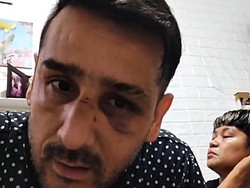 Wajah Lebam, Claudio Martines Buka Suara soal Pengeroyokan Pelayan Bar