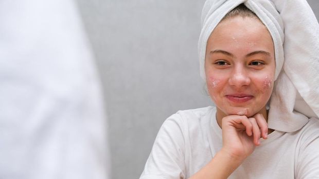 Acne. A smiling teenage girl with pimples on her face. Facial skin care. Problematic skin in adolescents.
