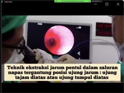 Tak Boleh Sembarangan, Begini Pertolongan Pertama Tersedak Jarum Pentul