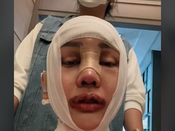 Wajah Baru Lucinta Luna Usai Operasi Potong Leher, Begini Penampakannya