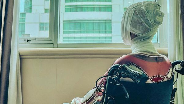 Potret Lucinta Luna Jalani Oplas Berkali-kali, Akhirnya Jahitan Dilepas