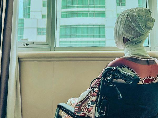 Potret Lucinta Luna Jalani Oplas Berkali-kali, Akhirnya Jahitan Dilepas