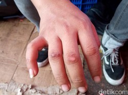 Kerap Dialami Penjual Ice Smoke, Ini Penampakan Luka Terbakar Nitrogen Cair