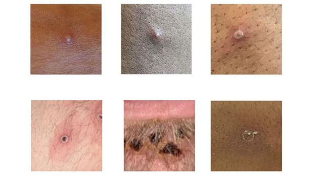 Pictures showing examples of rashes and lesions caused by the monkeypox virus are seen in this handout image obtained from official Centres for Disease Control and Prevention (CDC) website on July 1, 2022. UK Health Security Agency/CDC/Handout via REUTERS   THIS IMAGE HAS BEEN SUPPLIED BY A THIRD PARTY.
