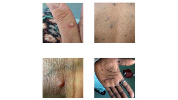 Pictures showing examples of rashes and lesions caused by the monkeypox virus are seen in this handout image obtained from official Centres for Disease Control and Prevention (CDC) website on July 1, 2022. NHS England High Consequence Infectious Diseases Network/CDC/Handout via REUTERS   THIS IMAGE HAS BEEN SUPPLIED BY A THIRD PARTY.