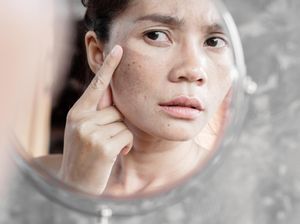 Mengenal Hiperpigmentasi, Penyebab & Cara Penanganannya Menurut Dokter Kulit Mengenal Hiperpigmentasi, Penyebab & Cara Penanganannya Menurut Dokter Kulit