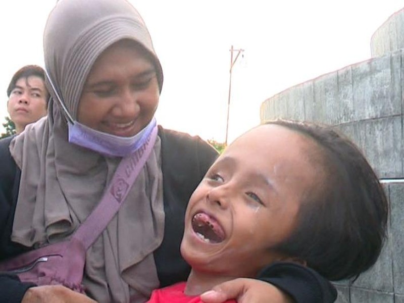 Derita Nia, Anak Kelainan Kerangka Kepala Digendong Ibu Jualan Kerupuk