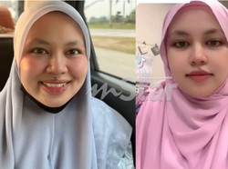 Viral Tahi Lalat di Wajah Wanita Ini Makin Besar, Cek ke Dokter Ternyata...