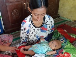 Tak Punya Anus Sejak Lahir, Bayi 2 Bulan di Gresik Butuh Uluran Bantuan