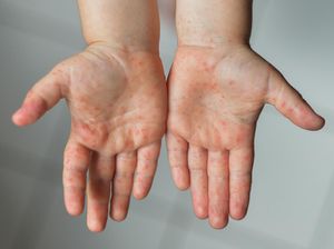 Masih Ada Ortu yang Tolak Anak Diimunisasi Meski Campak di Sumenep sudah KLB Masih Ada Ortu yang Tolak Anak Diimunisasi Meski Campak di Sumenep sudah KLB