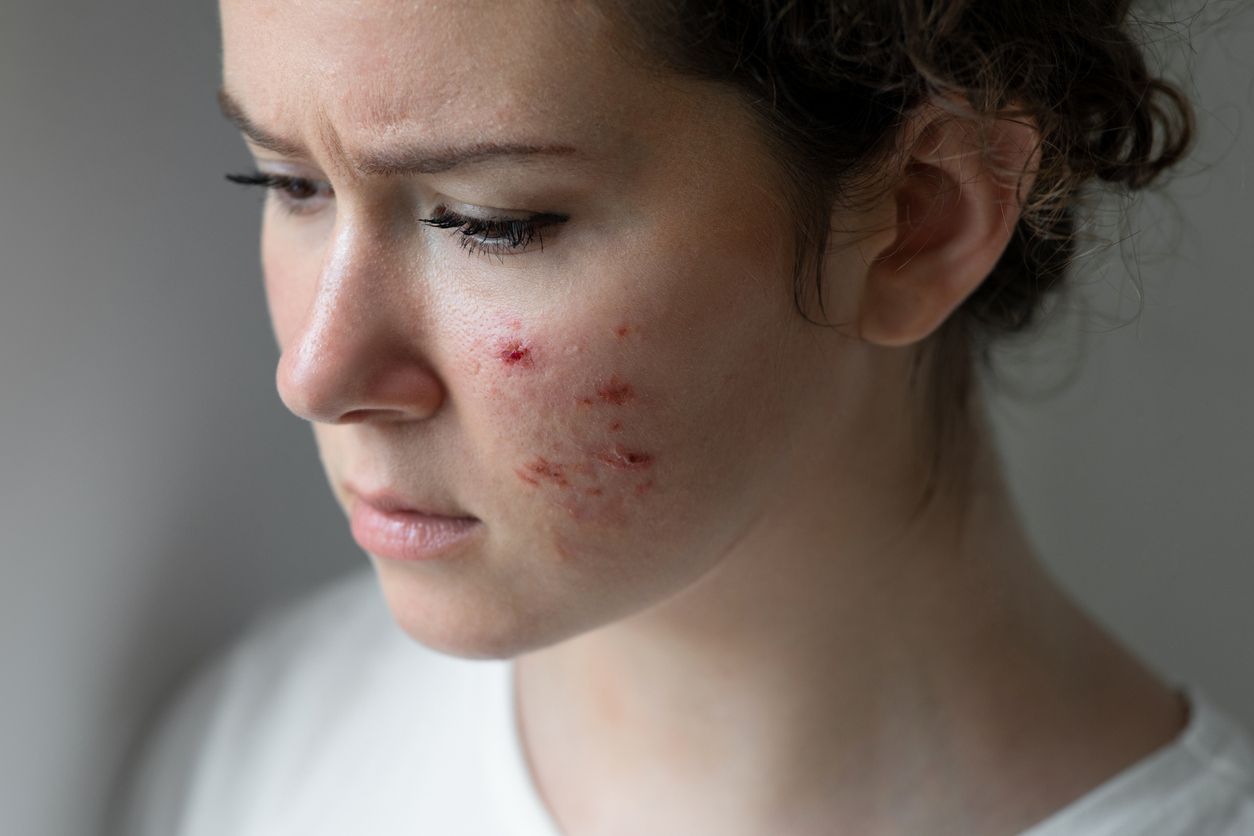 Female with acne