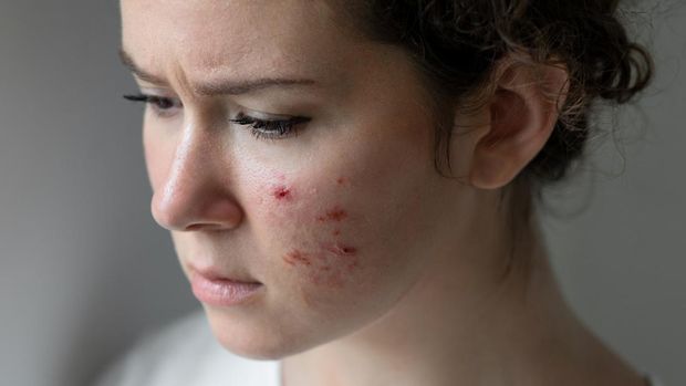 Female with acne
