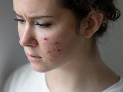 3 Bahan Dapur yang Efektif Sembuhkan Jerawat Bandel