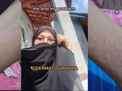 Viral Kulit Wanita Sukabumi Bisa Digambar Alami, Ternyata Idap Penyakit Ini